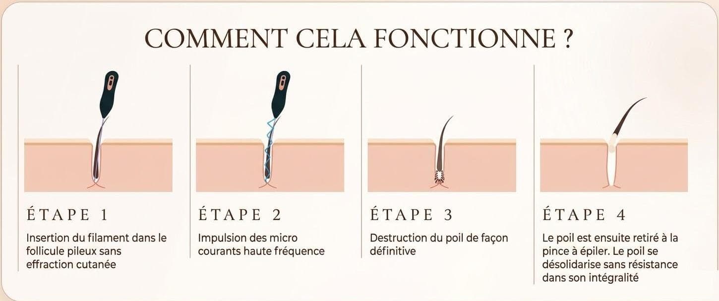 Illustration épilation définitive par électrolyse CherySkin